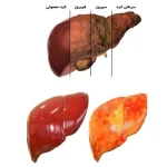 معجزه ای برای کبد چرب
