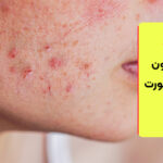 بهترین صابون برای جوش صورت نوجوان