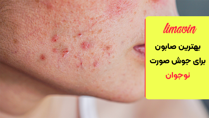 بهترین صابون برای جوش صورت نوجوان