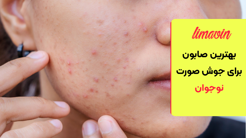 علت جوش صورت نوجوانان چیست؟