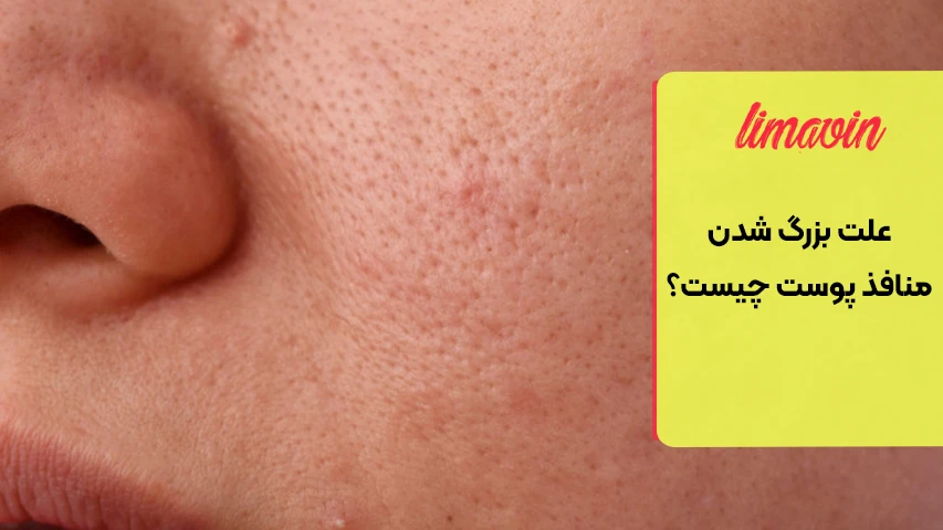 بزرگ شدن منافذ پوست در چه نواحی بیشتر دیده می شود؟