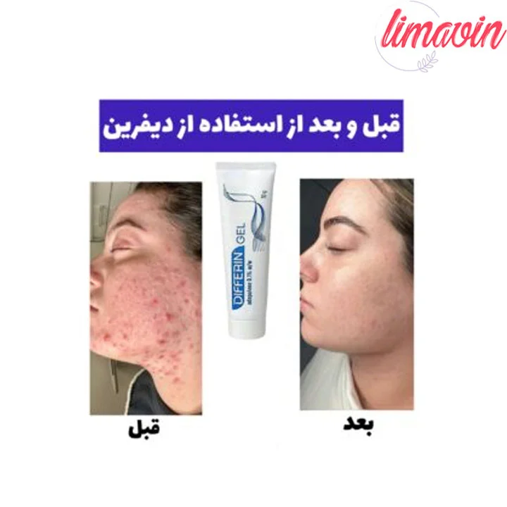 ژل ضد جوش دیفرین حجم 30 گرم - Image 2