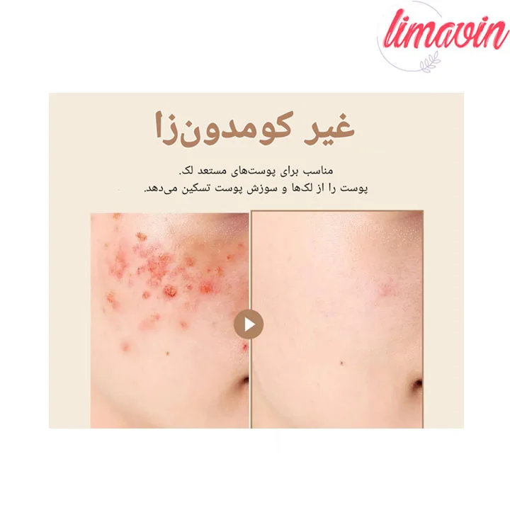 ژل کرم تسکین دهنده جو دوسر پیوریتو حجم 100 میلی لیتر - Image 5