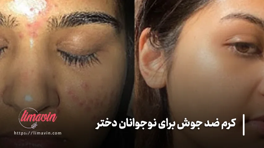 کرم مناسب برای هر نوع جوش نوجوانان