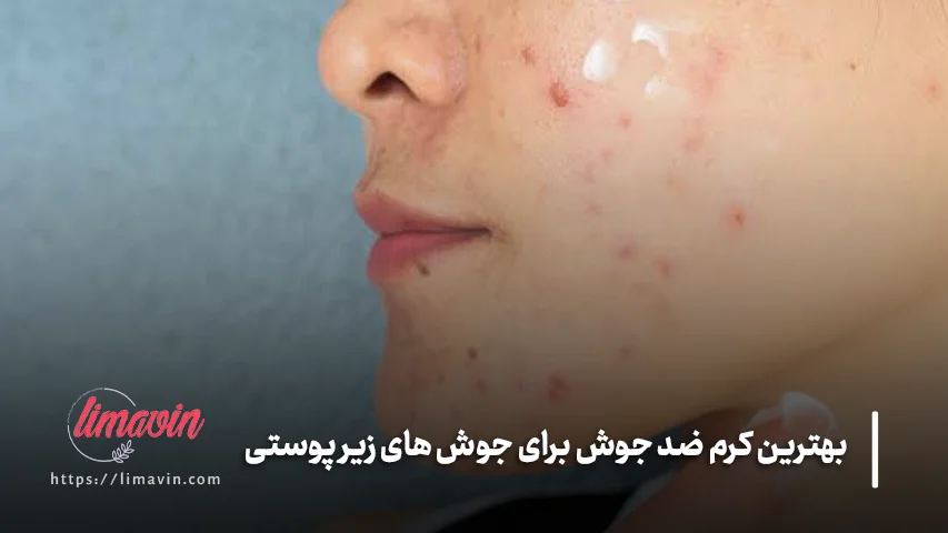 ۵ کرم و محصول ضد جوش مناسب برای جوش های زیر پوستی