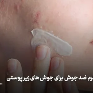 بهترین کرم ضد جوش برای جوش های زیر پوستی