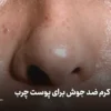 بهترین کرم ضد جوش برای پوست چرب