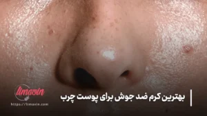 بهترین کرم ضد جوش برای پوست چرب