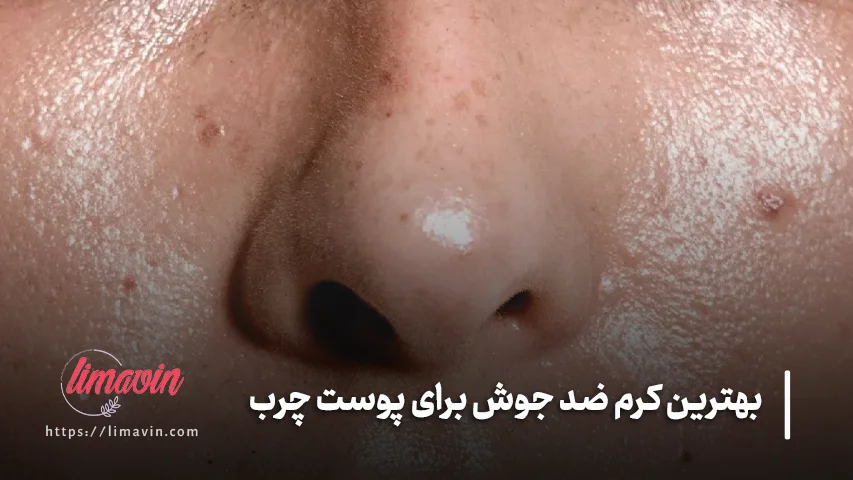 بهترین کرم ضد جوش برای پوست چرب