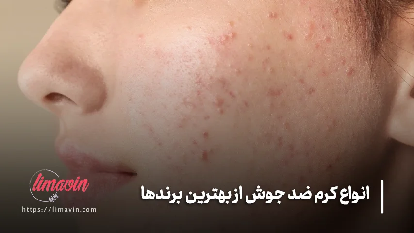 برای خرید کرم ضد جوش به چه ترکیباتی توجه کنیم؟